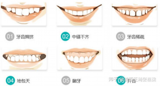 金属矫正器与陶瓷矫正器哪个效果好（正畸陶瓷还是金属好）(图1)